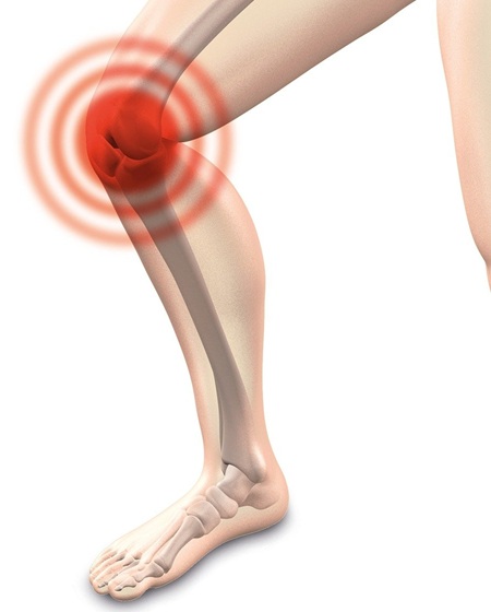 What is Negligence in Knee Replacement?